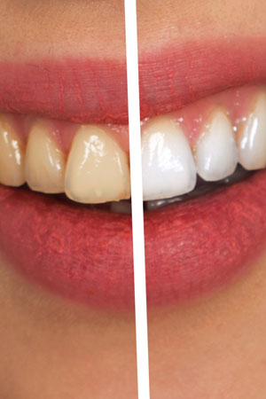 Teeth Whitening Photo